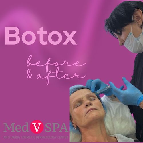 Botox Before and After.